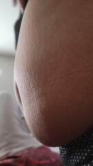 Close-up of Stretch Marks